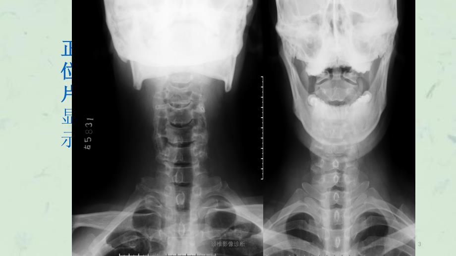 颈椎影像诊断课件_第3页