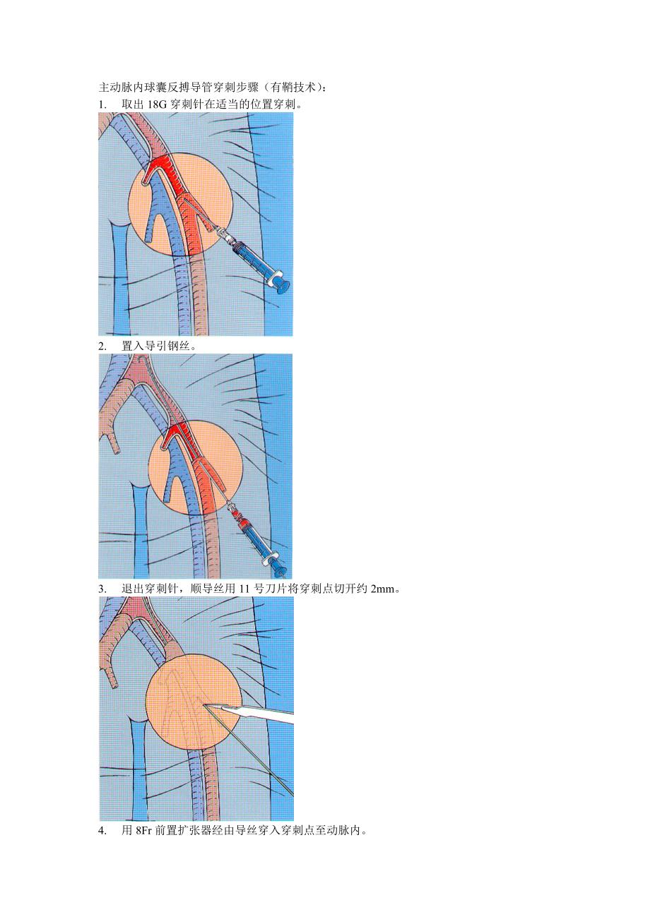 主动脉内球囊反搏导管穿刺步骤_第1页