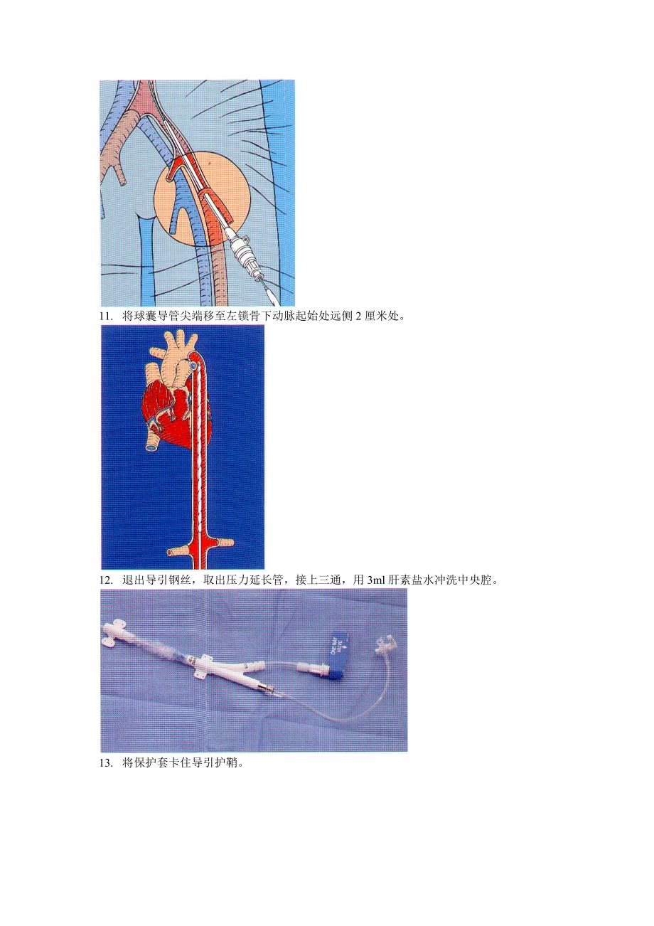 主动脉内球囊反搏导管穿刺步骤_第4页