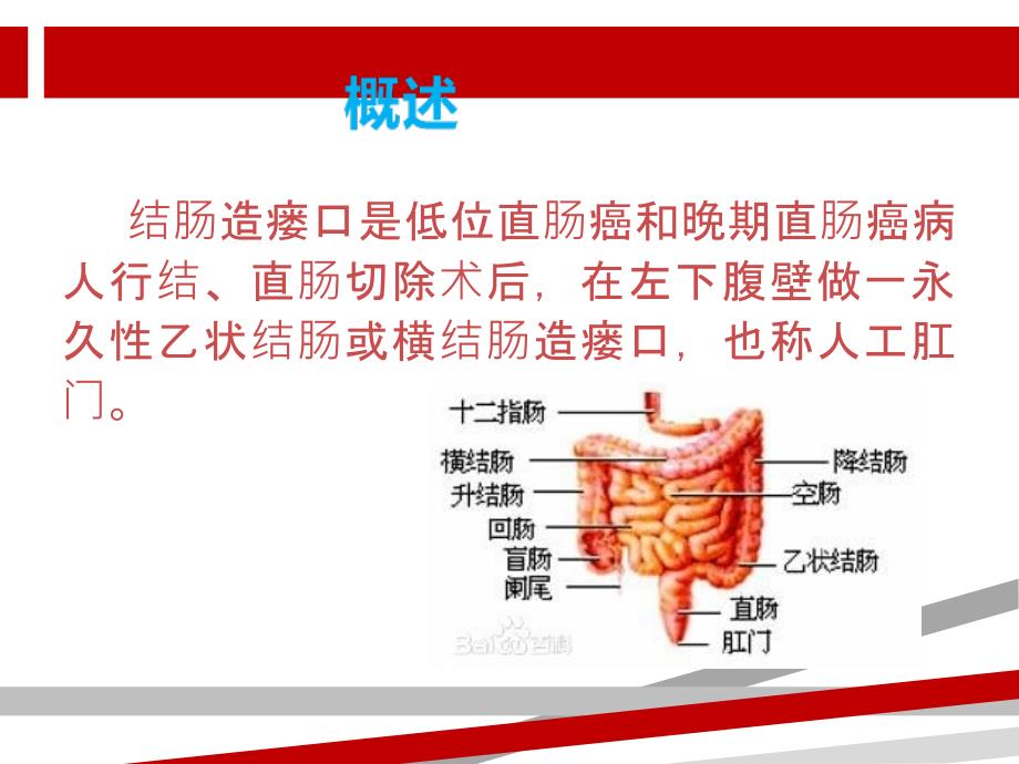 结肠造瘘口的护理.ppt课件_第2页