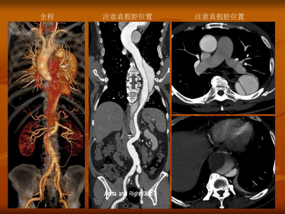 主动脉夹层腔内治疗的手术技巧_第4页