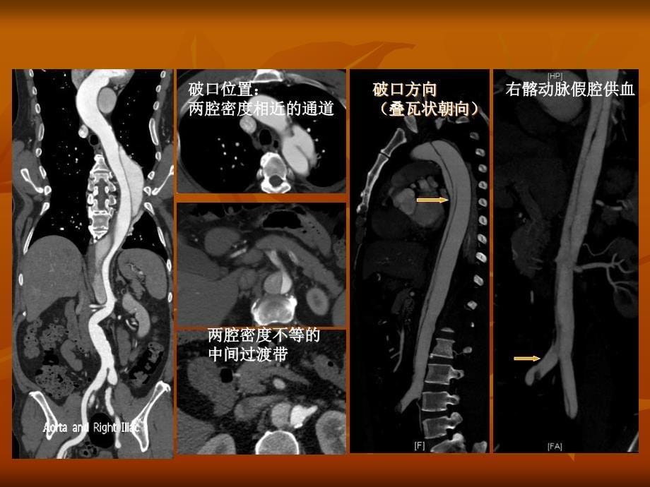 主动脉夹层腔内治疗的手术技巧_第5页