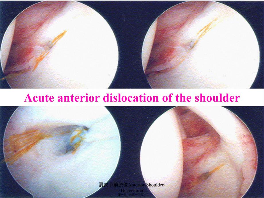 肩关节前脱位Anterior-Shoulder-Dislocation课件_第1页