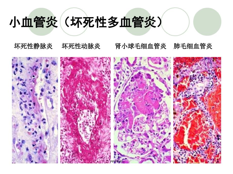 ANCA相关性血管炎--ppt课件_第4页