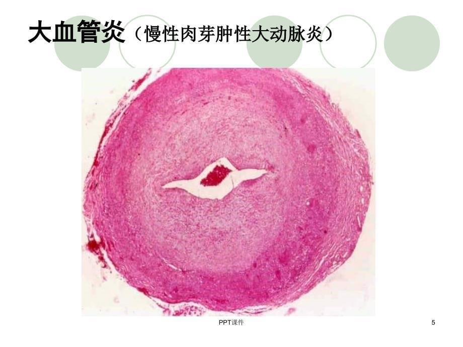 ANCA相关性血管炎--ppt课件_第5页