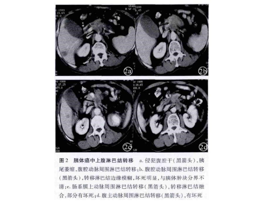 腹膜后淋巴结病变影像.ppt_第5页