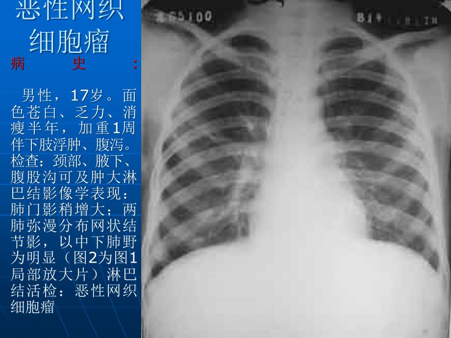 肺癌诊断PPT课件_第2页