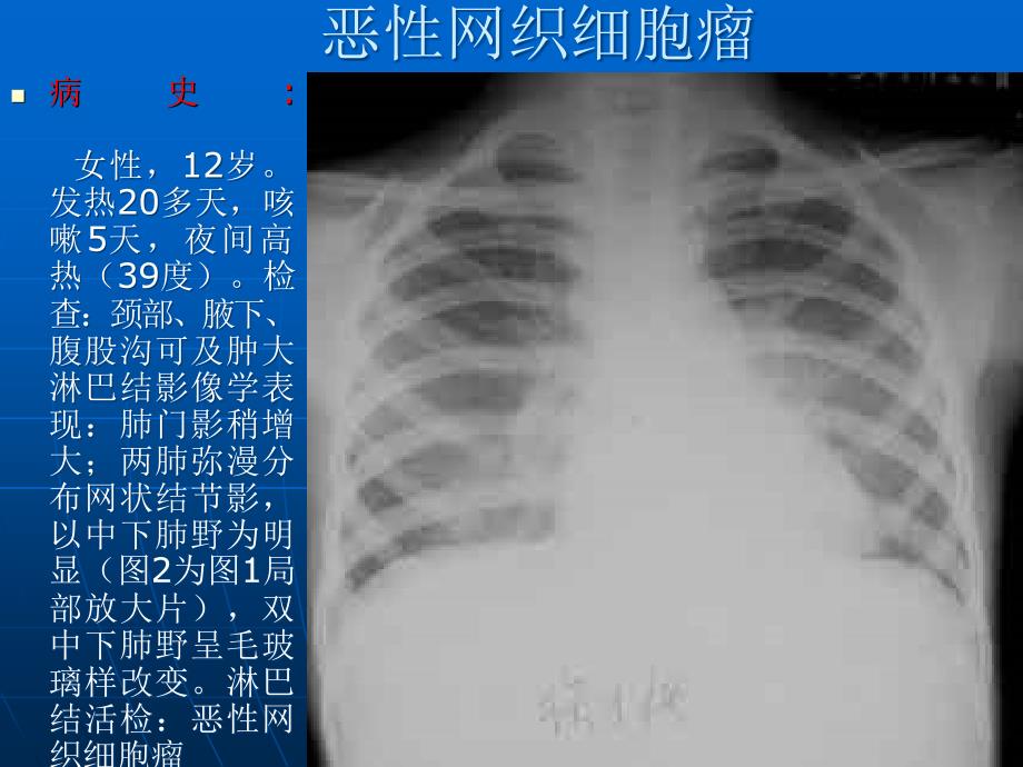 肺癌诊断PPT课件_第4页