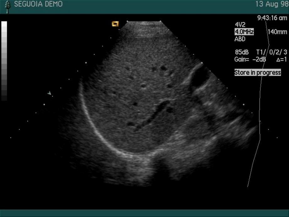 腹部疾病的超声诊断ppt课件_第4页