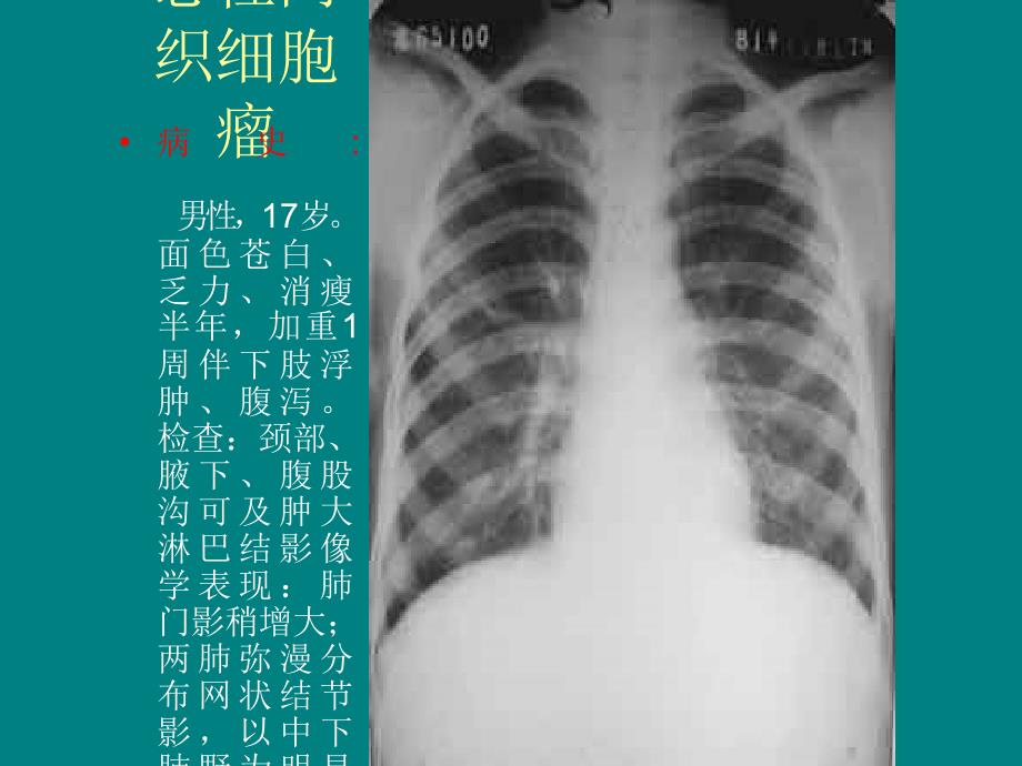 肺癌诊断1肺癌诊断_第2页