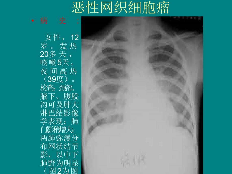 肺癌诊断1肺癌诊断_第4页