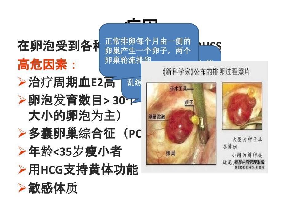 卵巢过度刺激综合征PPT_第5页