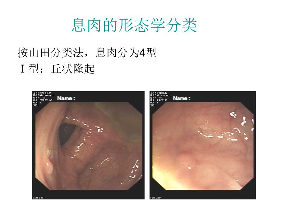 大肠息肉诊治ppt课件_第4页