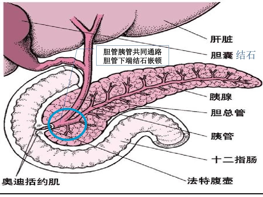 急性重症胰腺炎的护理新进展课件_第3页