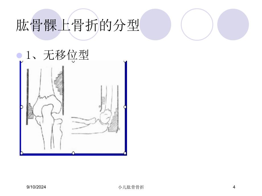 小儿肱骨骨折课件_第4页