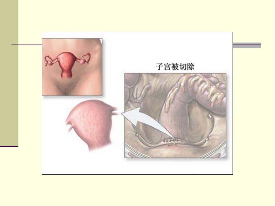 手术室护理操作——子宫切除术_第4页