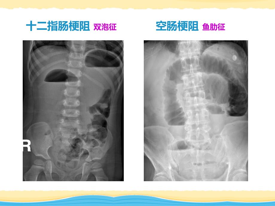 纯性肠梗阻影像表现_第5页