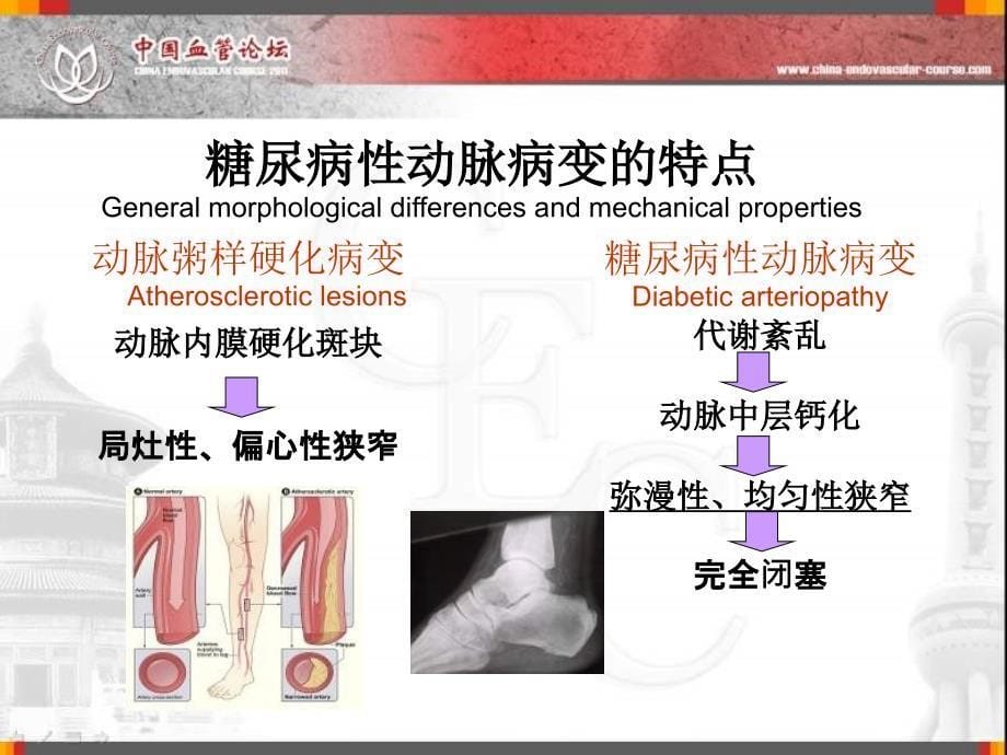 缺血糖尿病足CTO病变特点和治疗技术课件_第5页