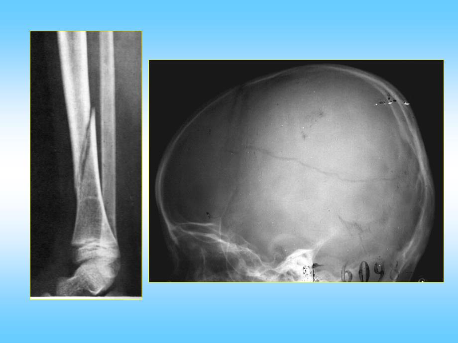 骨关节创伤精选幻灯片_第3页