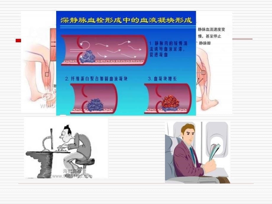 康复患者下肢静脉血栓防治_第5页