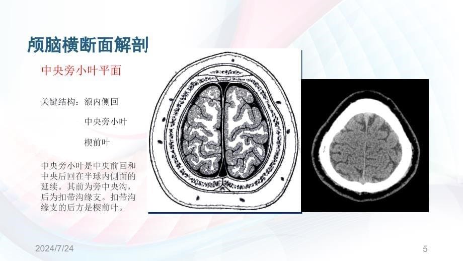 神经系统颅脑CT影像断层解剖及正常CT表现ppt参考课件_第5页