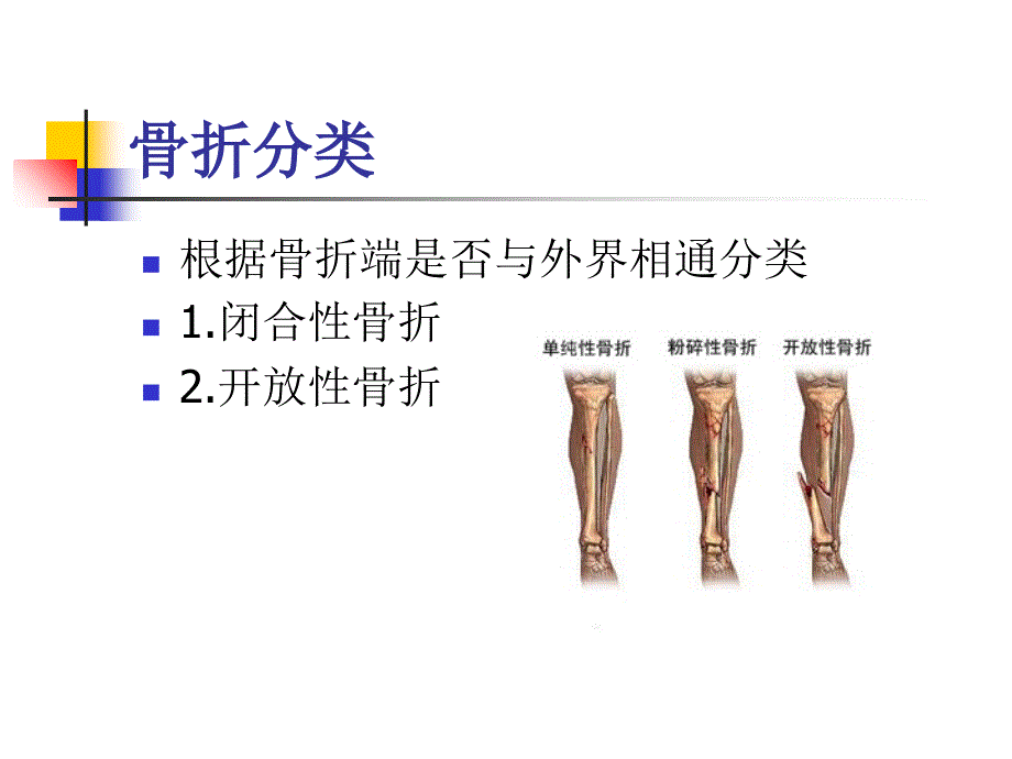 骨折病人护理ppt课件_第4页