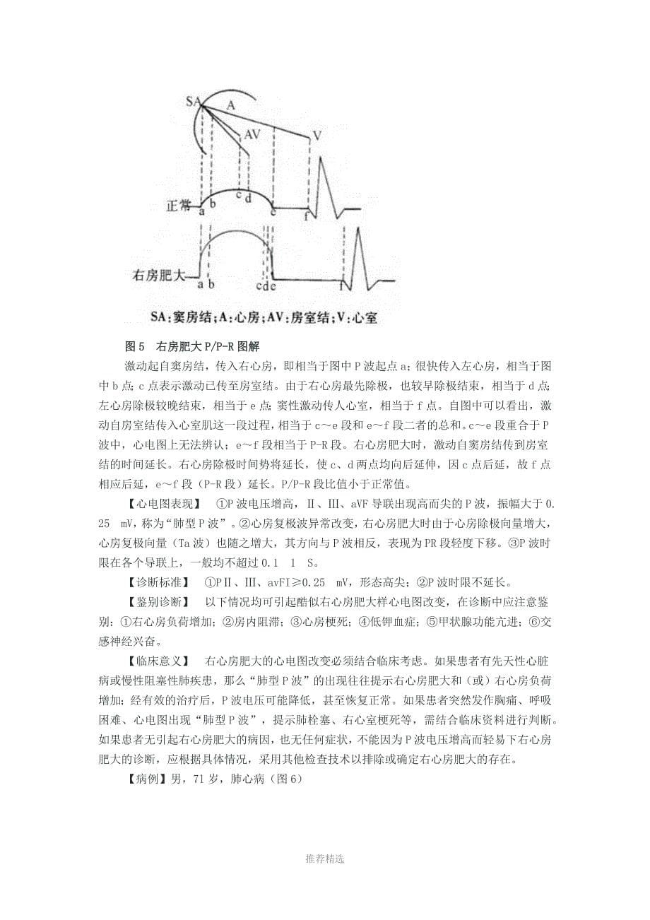 图解心房心室肥大的心电图诊断_第5页