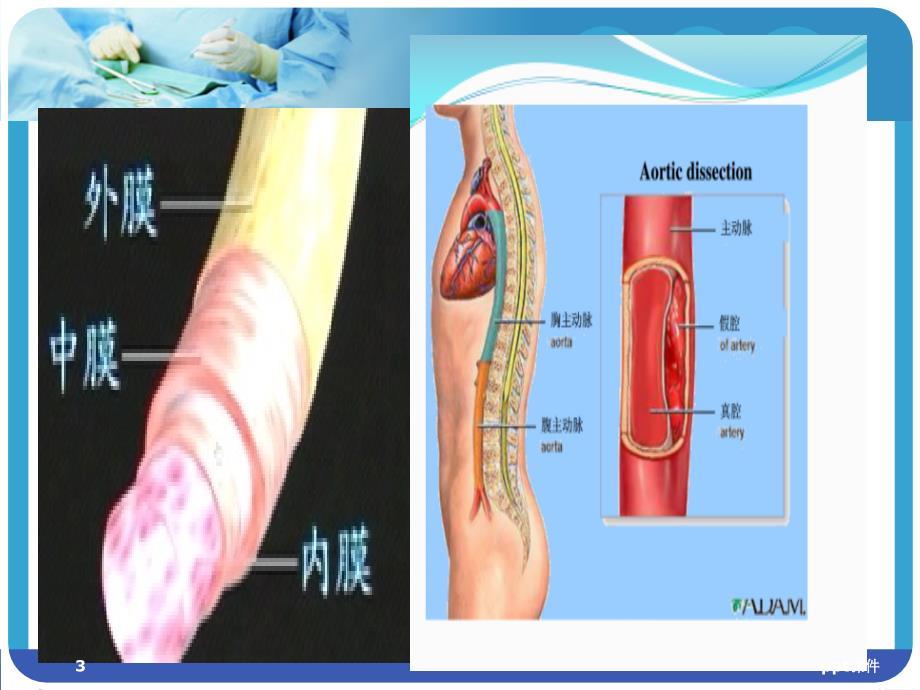 主动脉夹层护理查房ppt课件_第3页