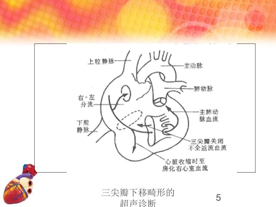 三尖瓣下移畸形的超声诊断培训课件_第5页