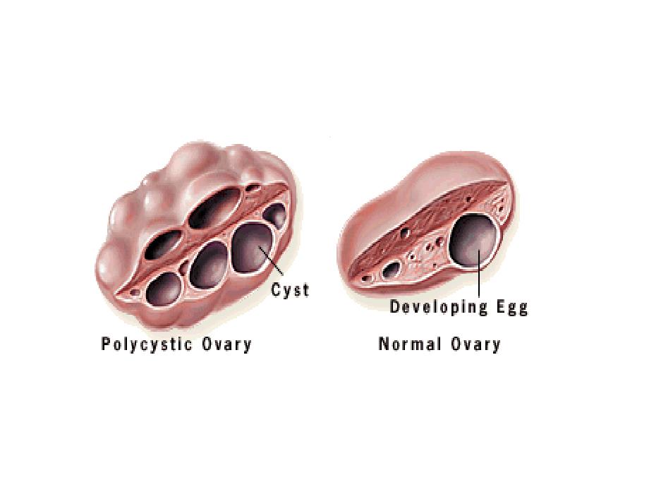 组织学与胚胎学：多囊卵巢综合征_第2页
