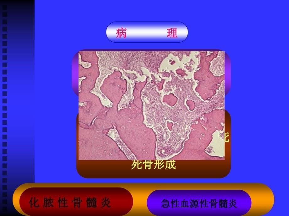 骨与关节感染课件_第5页