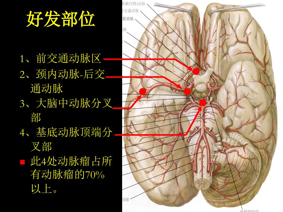 颅内动脉瘤PPT课件_第4页