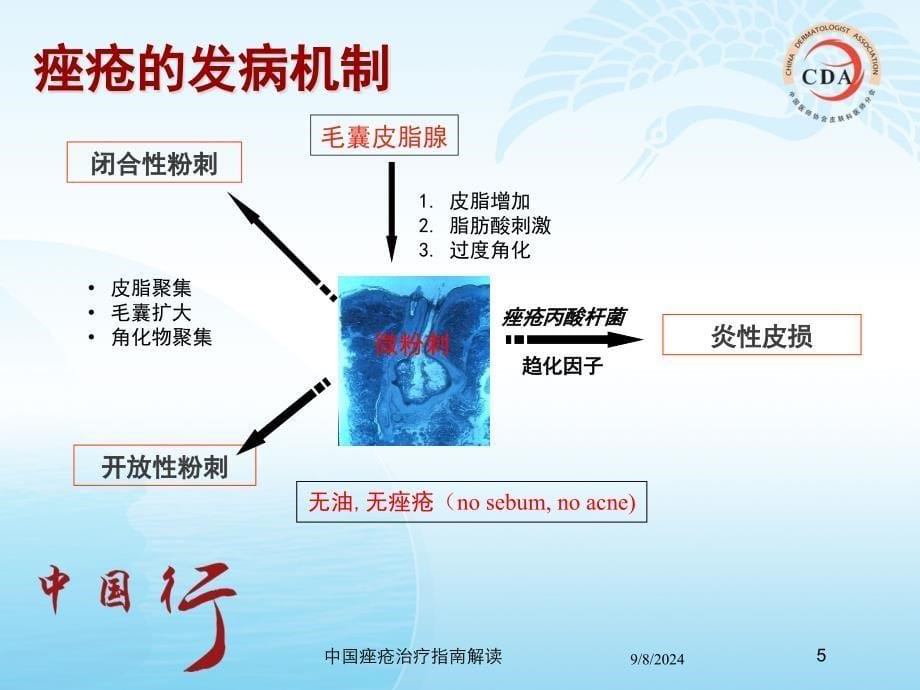 中国痤疮治疗指南解读培训课件_第5页