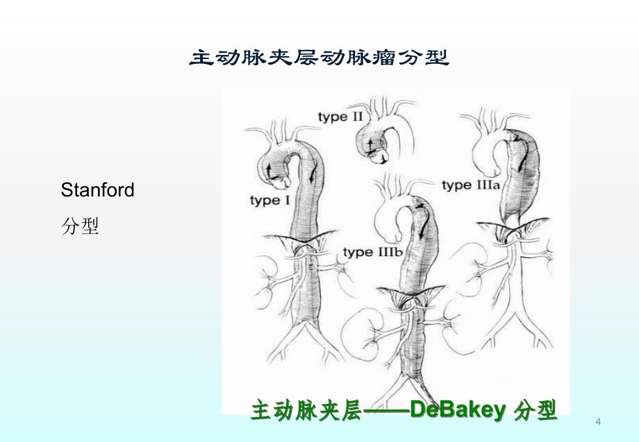 主动脉夹层动脉瘤诊断与治疗策略ppt课件_第4页