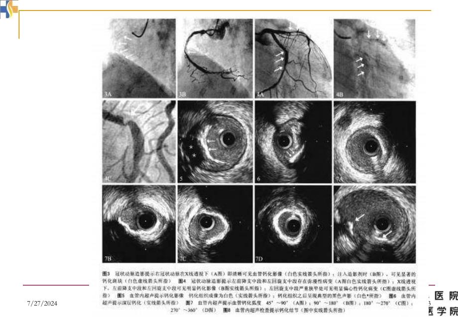 严重冠状动脉钙化病变治疗策略_第3页