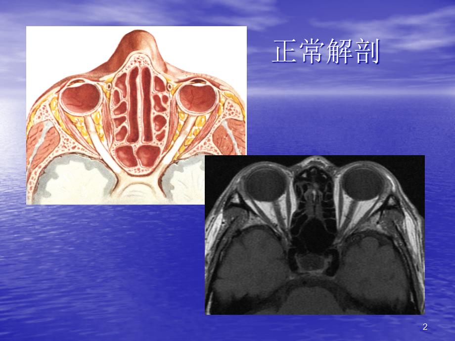 眼眶及眼球病变MR表现课件_第2页