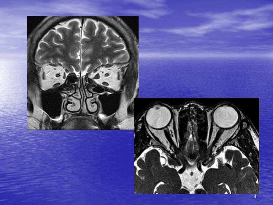 眼眶及眼球病变MR表现课件_第4页
