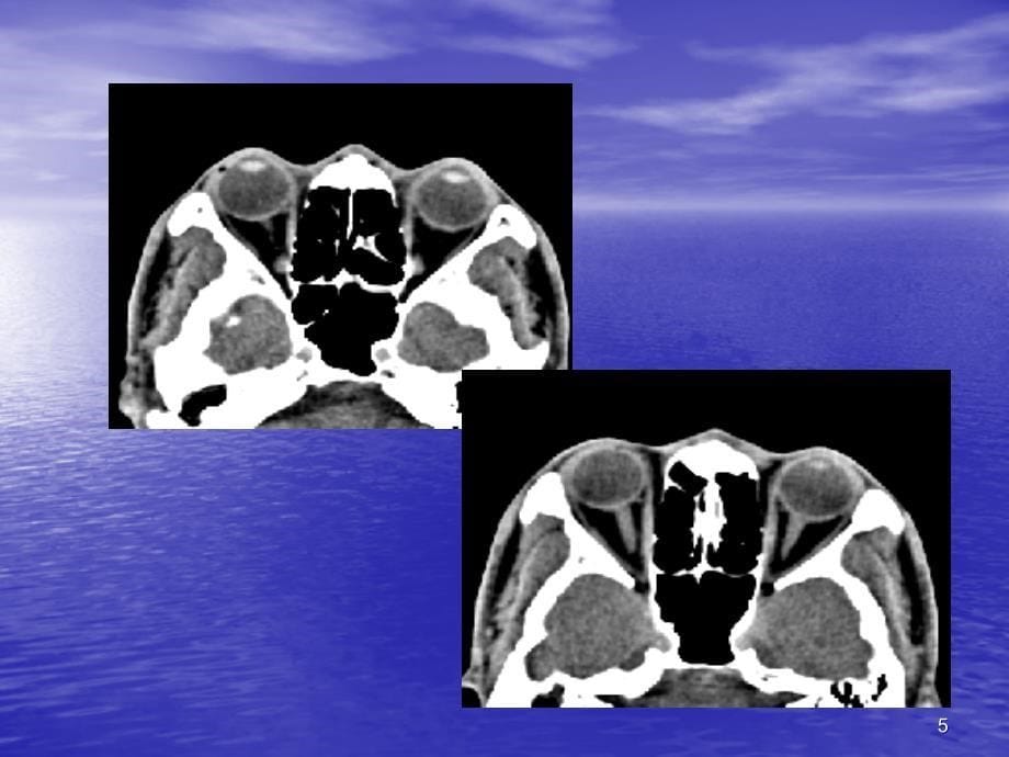 眼眶及眼球病变MR表现课件_第5页