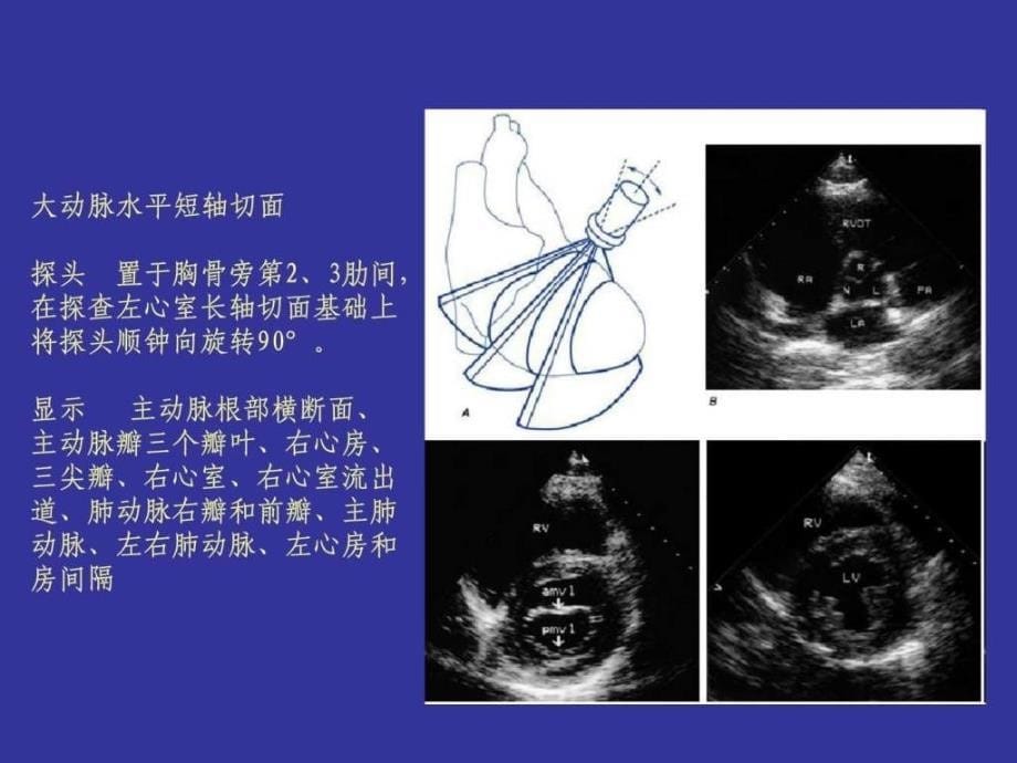 心脏超声图文1671711932.ppt_第5页