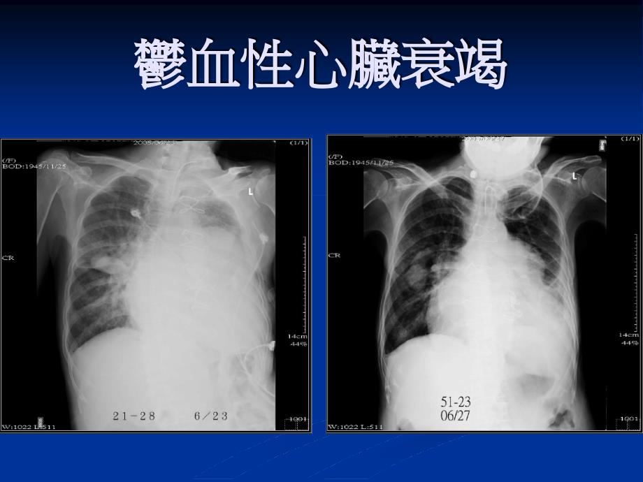 医疗安全暨品质讨论会郁血性心脏病患之肺部复健与居家呼吸_第4页