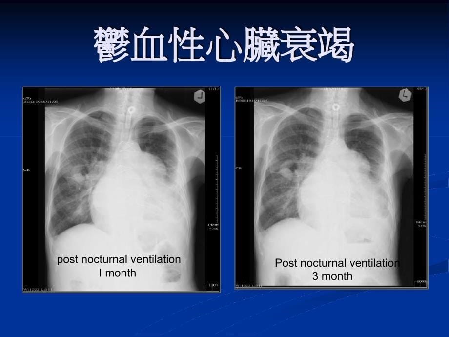 医疗安全暨品质讨论会郁血性心脏病患之肺部复健与居家呼吸_第5页