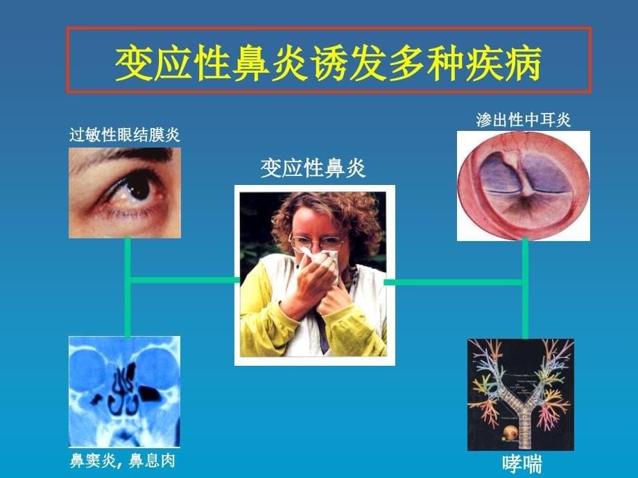 变应性鼻炎再认识和进展_第5页