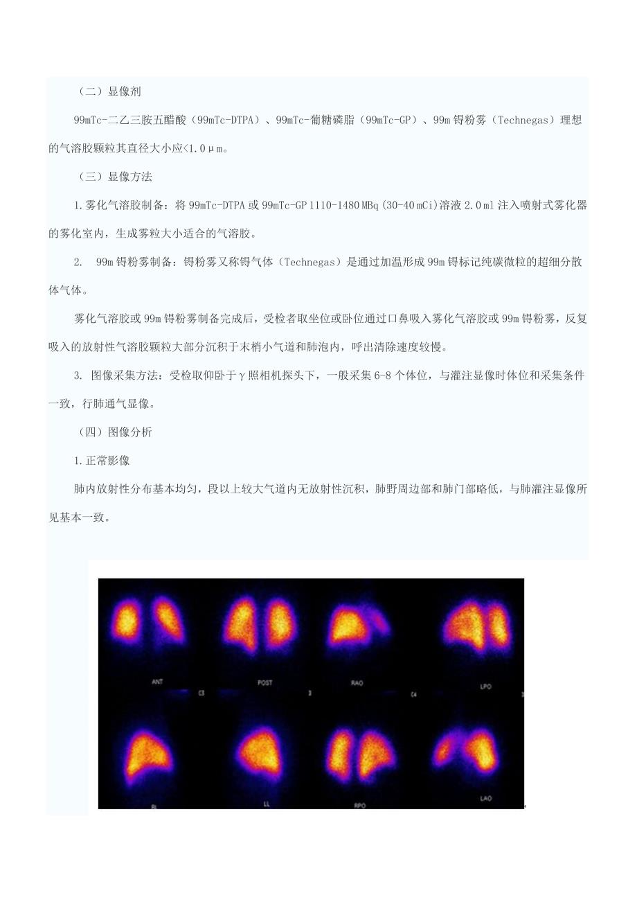 肺灌注通气显像在肺栓塞中的应用_第4页