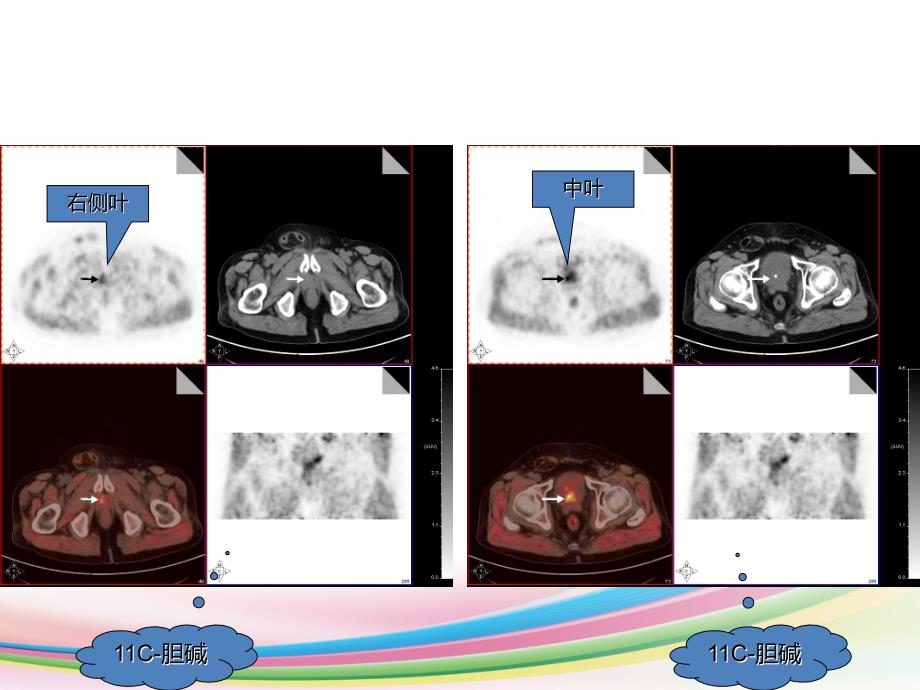 胆碱 PET CT 前列腺癌_第3页