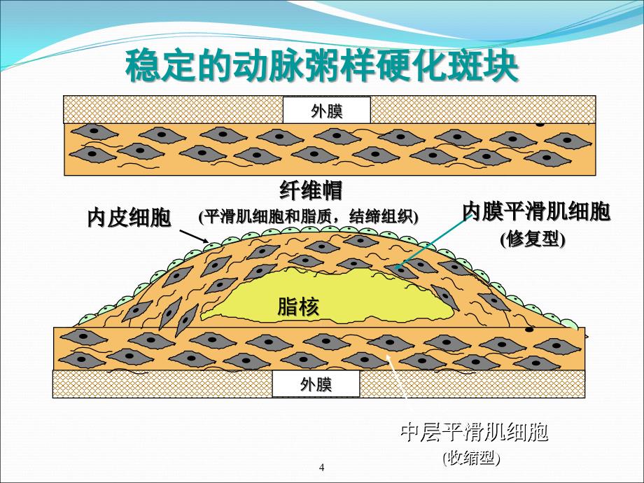 冠心病课件_第4页