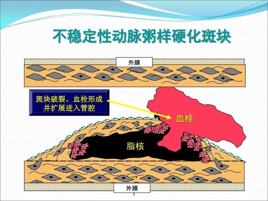 冠心病课件_第5页