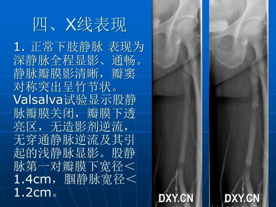 下肢深静脉造影1_第5页