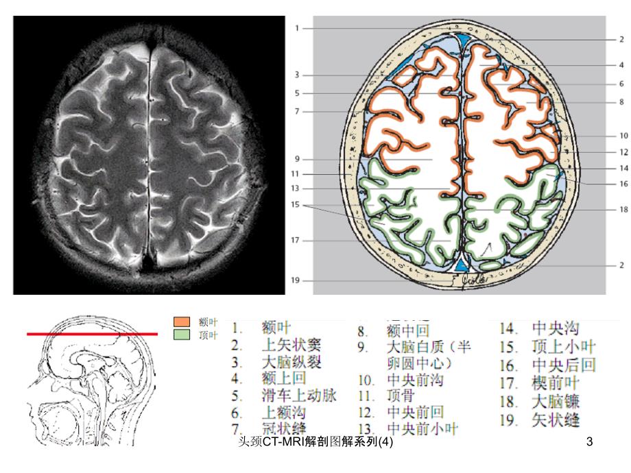 头颈CTMRI解剖图解系列4课件_第3页