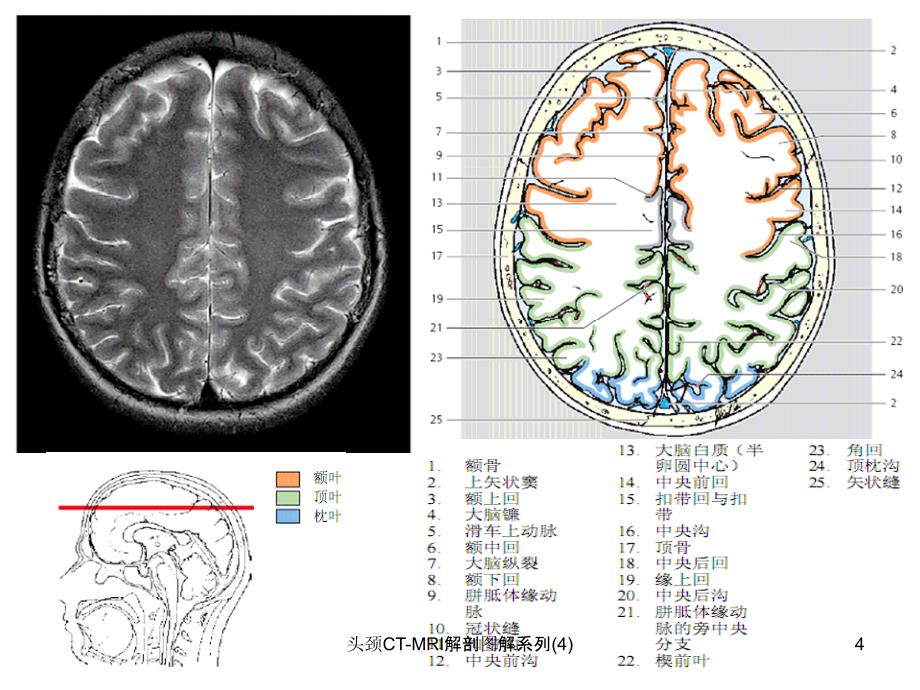 头颈CTMRI解剖图解系列4课件_第4页
