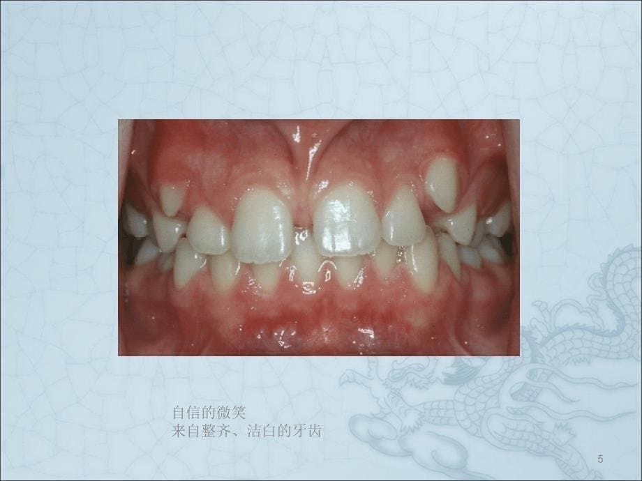 功能性矫治器MRCppt课件_第5页